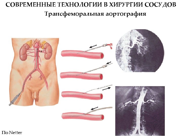 СОВРЕМЕННЫЕ ТЕХНОЛОГИИ В ХИРУРГИИ СОСУДОВ Трансфеморальная аортография По Netter 