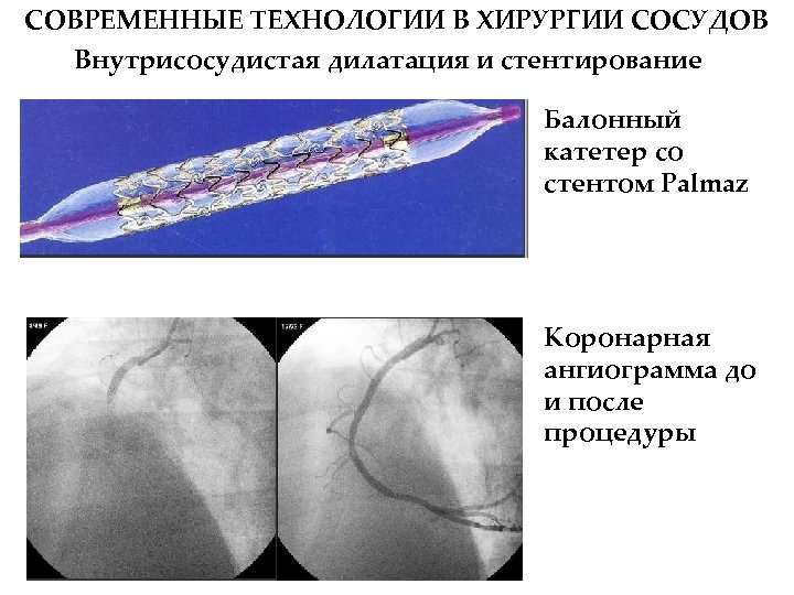 СОВРЕМЕННЫЕ ТЕХНОЛОГИИ В ХИРУРГИИ СОСУДОВ Внутрисосудистая дилатация и стентирование Балонный катетер со стентом Palmaz