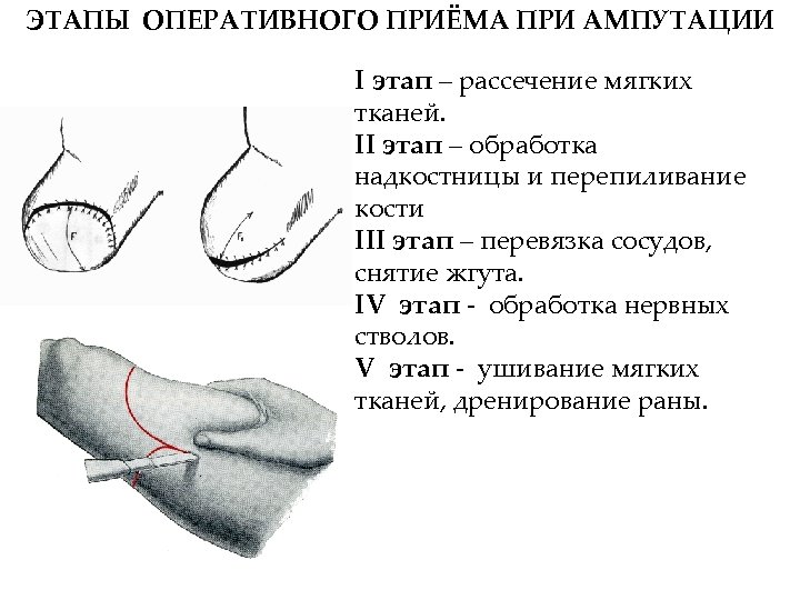 ЭТАПЫ ОПЕРАТИВНОГО ПРИЁМА ПРИ АМПУТАЦИИ I этап – рассечение мягких тканей. II этап –