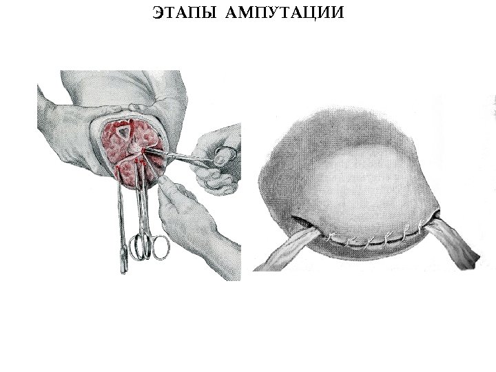 ЭТАПЫ АМПУТАЦИИ 