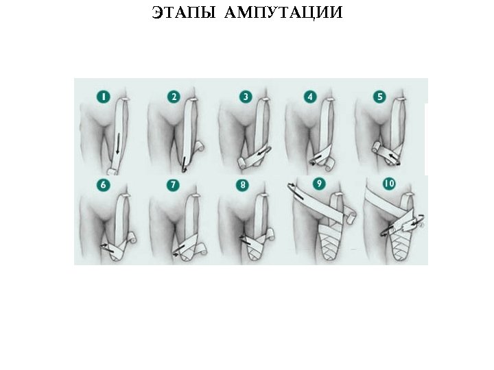 ЭТАПЫ АМПУТАЦИИ 