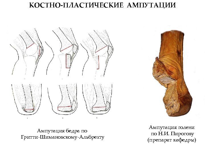 Ампутация на уровне средней трети. Ампутация Гритти-Шимановскому бедра. Операция ампутации бедра по Гритти-Шимановскому-Альбрехту. Ампутация костно пластическая ампутация по Гритти Шимановскому. Костно-пластическая ампутация бедра по Гритти-Шимановскому.