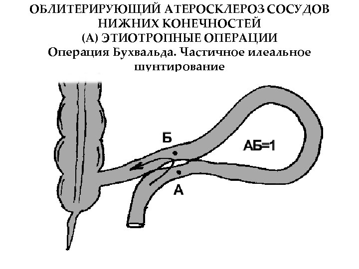 Операция на артерии нижних. Атеросклероз артерий нижних конечностей операция. Операция при атеросклерозе сосудов. Атеросклеротические поражения артерий нижних конечностей хирургия. Облитерирующий атеросклероз вен нижних конечностей.