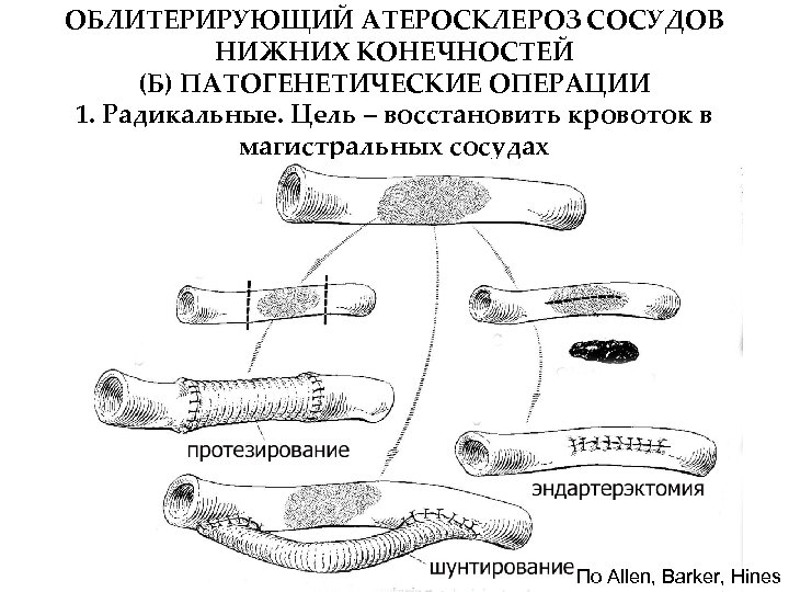 ОБЛИТЕРИРУЮЩИЙ АТЕРОСКЛЕРОЗ СОСУДОВ НИЖНИХ КОНЕЧНОСТЕЙ (Б) ПАТОГЕНЕТИЧЕСКИЕ ОПЕРАЦИИ 1. Радикальные. Цель – восстановить кровоток