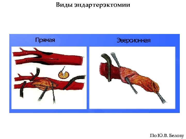 После каротидной эндартерэктомии. Эверсионная каротидная эндартерэктомия слева что это. Эверсионная эндартерэктомия сонной артерии.