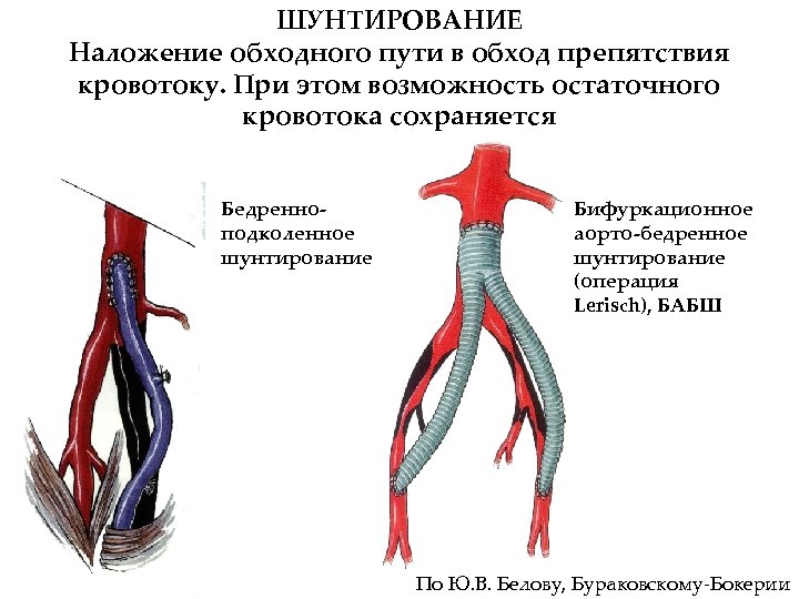 ШУНТИРОВАНИЕ Наложение обходного пути в обход препятствия кровотоку. При этом возможность остаточного кровотока сохраняется