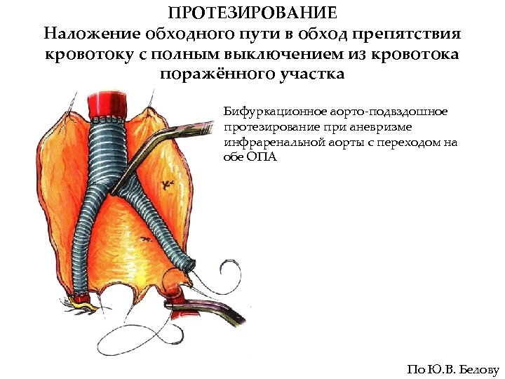 ПРОТЕЗИРОВАНИЕ Наложение обходного пути в обход препятствия кровотоку с полным выключением из кровотока поражённого