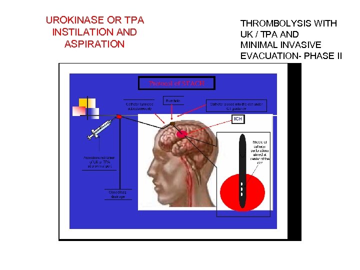 UROKINASE OR TPA INSTILATION AND ASPIRATION THROMBOLYSIS WITH UK / TPA AND MINIMAL INVASIVE