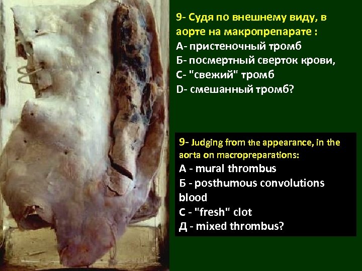 9 - Судя по внешнему виду, в аорте на макропрепарате : А- пристеночный тромб