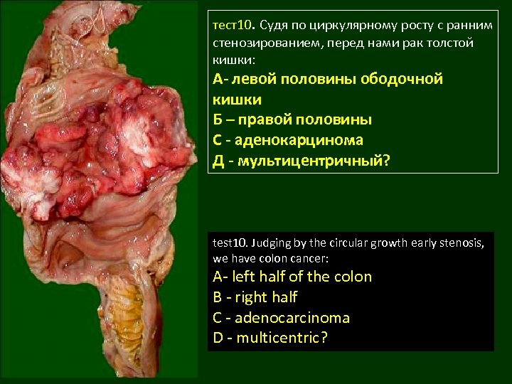тест10. Судя по циркулярному росту с ранним стенозированием, перед нами рак толстой кишки: А-