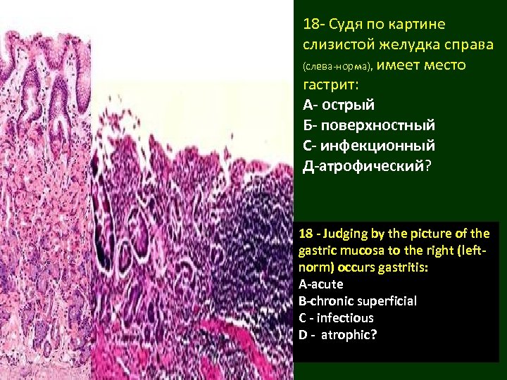 18 - Судя по картине слизистой желудка справа (слева-норма), имеет место гастрит: А- острый