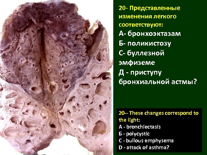 20 - Представленные изменения легкого соответствуют: А- бронхоэктазам Б- поликистозу С- буллезной эмфиземе Д