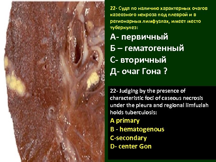 22 - Судя по наличию характерных очагов казеозного некроза под плеврой и в регионарных
