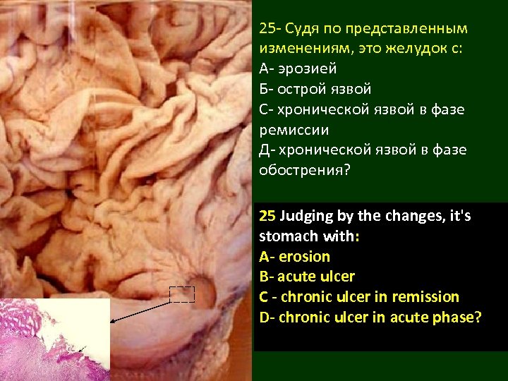 25 - Судя по представленным изменениям, это желудок с: А- эрозией Б- острой язвой