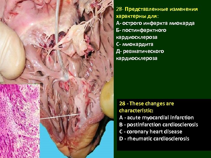 28 - Представленные изменения характерны для: А- острого инфаркта миокарда Б- постинфарктного кардиосклероза С-
