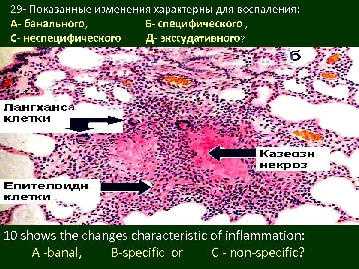 29 - Показанные изменения характерны для воспаления: А- банального, Б- специфического , С- неспецифического