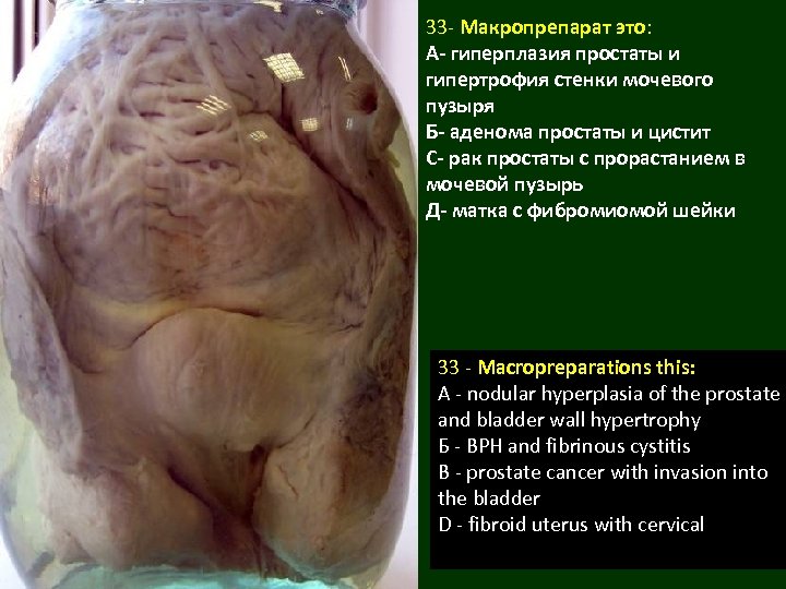 33 - Макропрепарат это: А- гиперплазия простаты и гипертрофия стенки мочевого пузыря Б- аденома