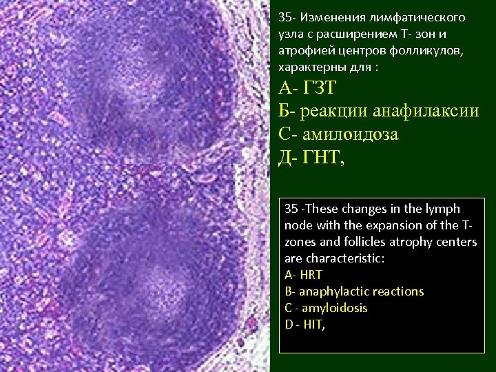 35 - Изменения лимфатического узла с расширением Т- зон и атрофией центров фолликулов, характерны