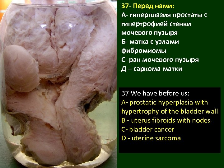 37 - Перед нами: А- гиперплазия простаты с гипертрофией стенки мочевого пузыря Б- матка