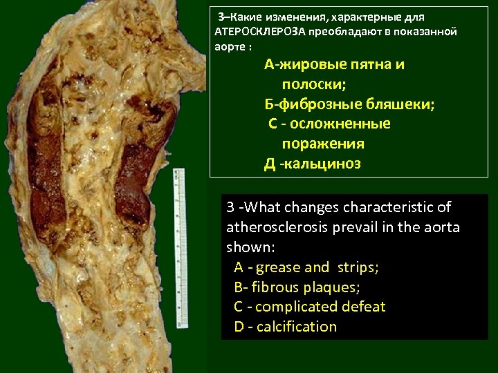  3–Какие изменения, характерные для АТЕРОСКЛЕРОЗА преобладают в показанной аорте : А-жировые пятна и