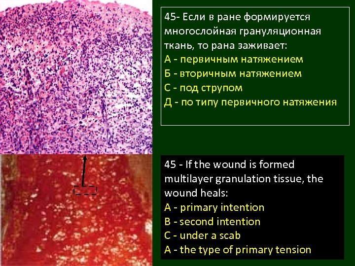 45 - Если в ране формируется многослойная грануляционная ткань, то рана заживает: А -