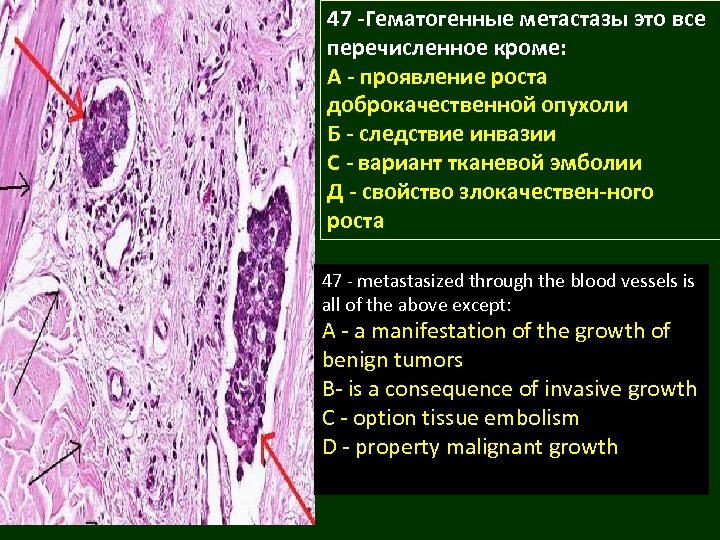 47 -Гематогенные метастазы это все перечисленное кроме: А - проявление роста доброкачественной опухоли Б