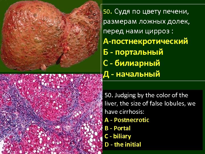 50. Судя по цвету печени, размерам ложных долек, перед нами цирроз : А-постнекротический Б