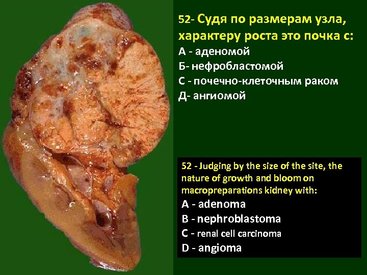 52 - Судя по размерам узла, характеру роста это почка с: А - аденомой