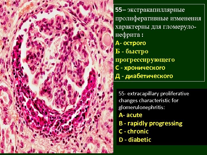 55– экстракапиллярные пролиферативные изменения характерны для гломерулонефрита : A- острого Б - быстро прогрессирующего