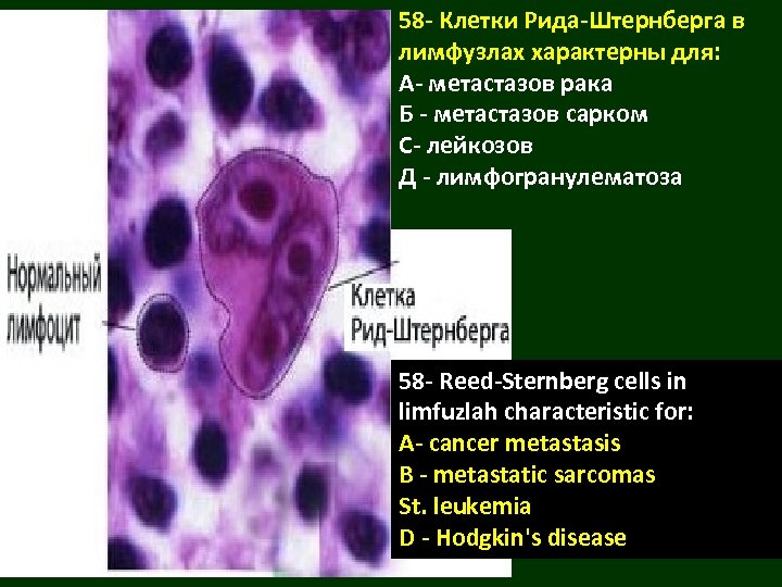 58 - Клетки Рида-Штернберга в лимфузлах характерны для: А- метастазов рака Б - метастазов