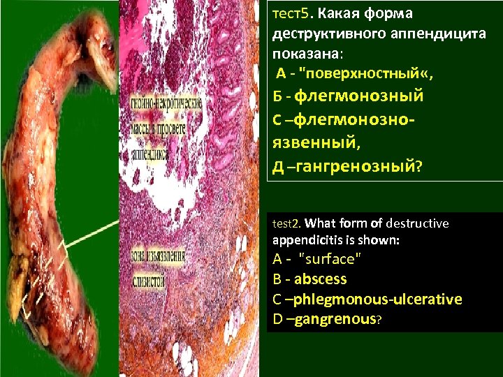 тест5. Какая форма деструктивного аппендицита показана: А - 