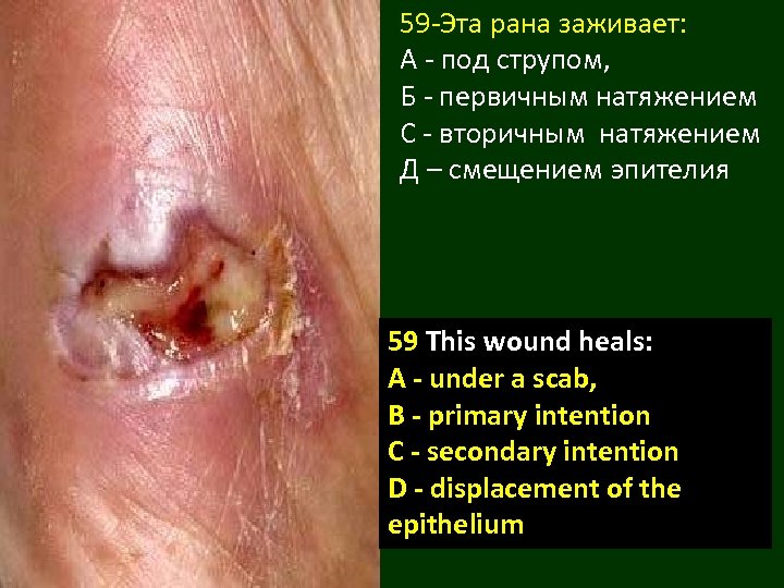 59 -Эта рана заживает: А - под струпом, Б - первичным натяжением С -