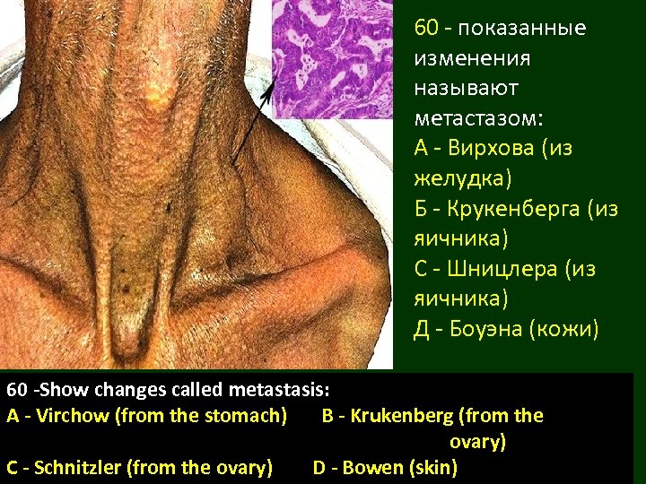 60 - показанные изменения называют метастазом: А - Вирхова (из желудка) Б - Крукенберга