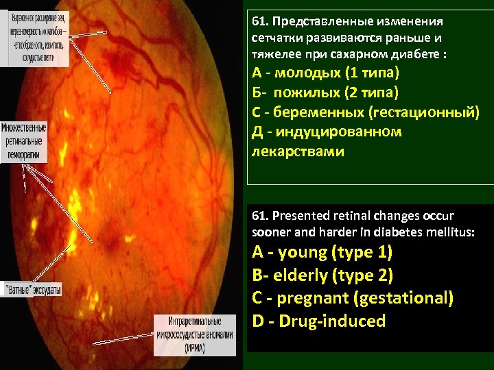 61. Представленные изменения сетчатки развиваются раньше и тяжелее при сахарном диабете : А -