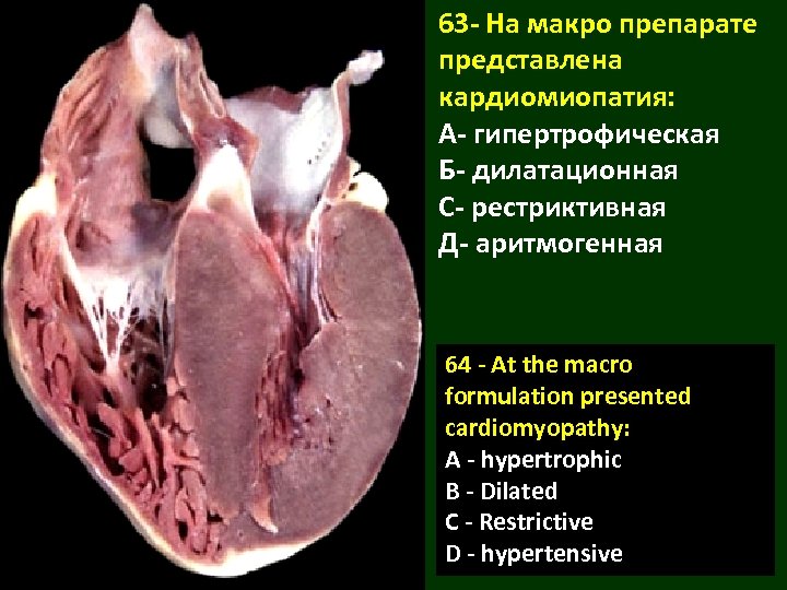 63 - На макро препарате представлена кардиомиопатия: А- гипертрофическая Б- дилатационная С- рестриктивная Д-