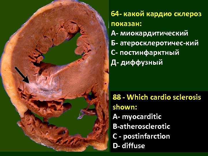 64 - какой кардио склероз показан: А- миокардитический Б- атеросклеротичес-кий С- постинфарктный Д- диффузный
