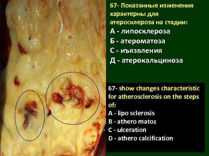67 - Показанные изменения характерны для атеросклероза на стадии: А - липосклероза Б -