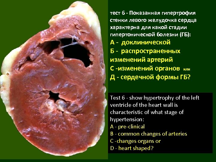 тест 6 - Показанная гипертрофия стенки левого желудочка сердца характерна для какой стадии гипертонической