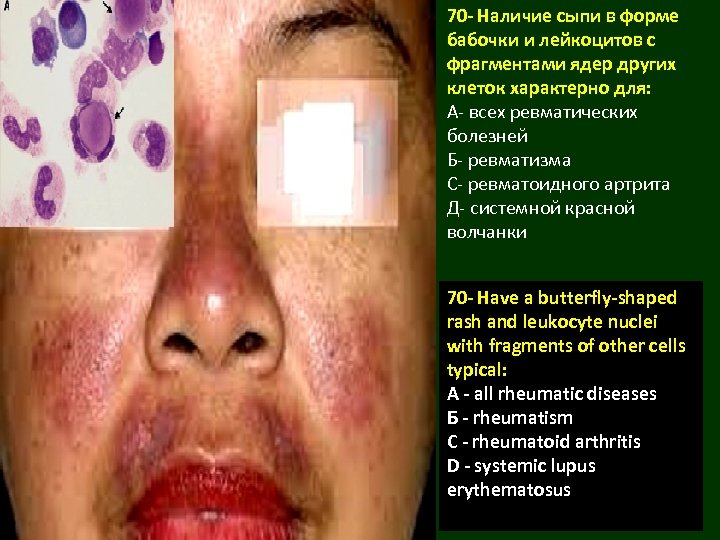 70 - Наличие сыпи в форме бабочки и лейкоцитов с фрагментами ядер других клеток
