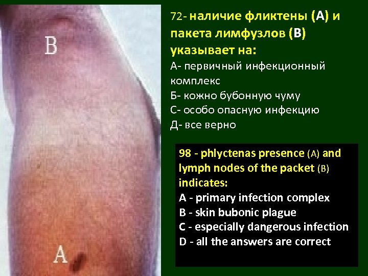 72 - наличие фликтены (А) и пакета лимфузлов (В) указывает на: А- первичный инфекционный