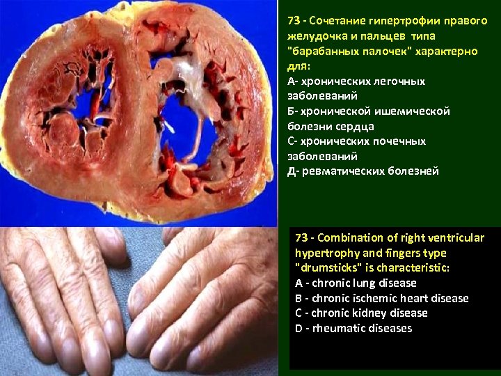 73 - Сочетание гипертрофии правого желудочка и пальцев типа 