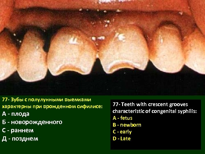 77 - Зубы с полулунными выемками характерны при врожденном сифилисе: А - плода Б