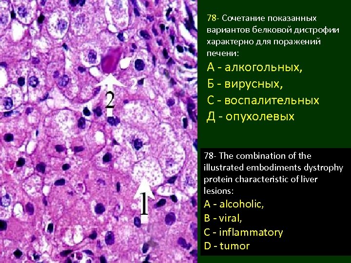 78 - Сочетание показанных вариантов белковой дистрофии характерно для поражений печени: А - алкогольных,