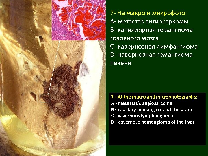 7 - На макро и микрофото: A- метастаз ангиосаркомы B- капиллярная гемангиома головного мозга