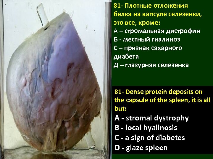 81 - Плотные отложения белка на капсуле селезенки, это все, кроме: А – стромальная