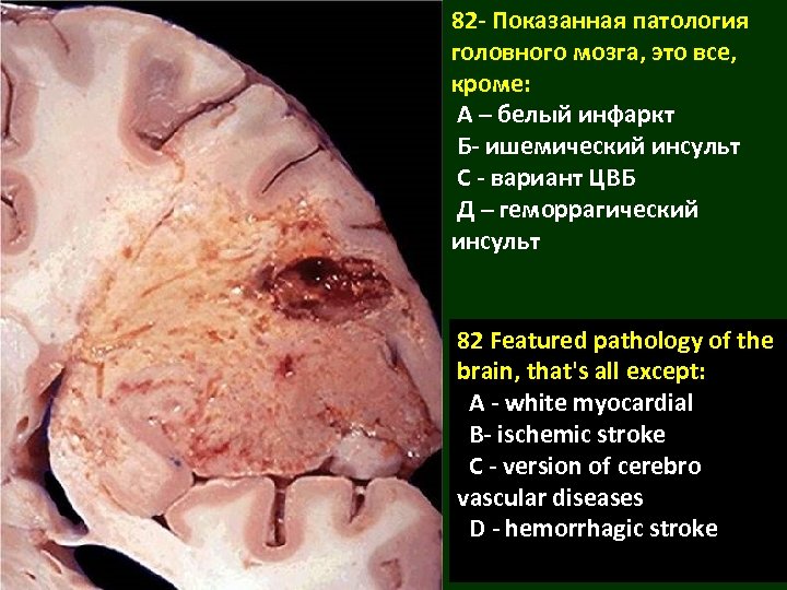 82 - Показанная патология головного мозга, это все, кроме: А – белый инфаркт Б-