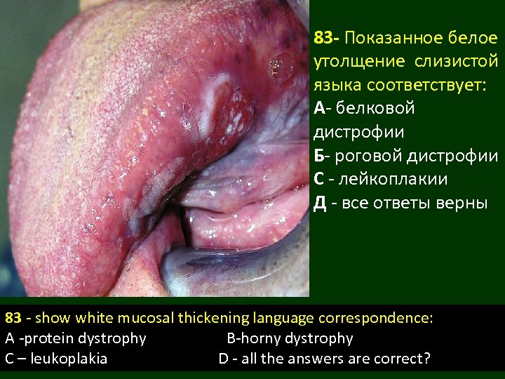 83 - Показанное белое утолщение слизистой языка соответствует: А- белковой дистрофии Б- роговой дистрофии