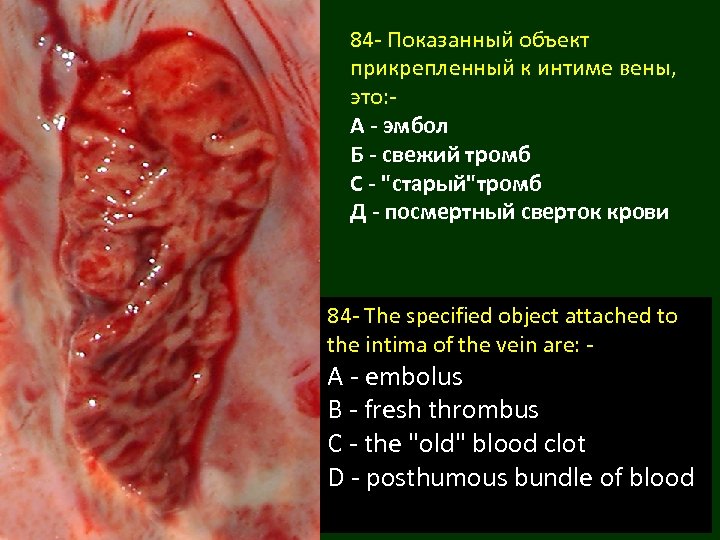84 - Показанный объект прикрепленный к интиме вены, это: А - эмбол Б -