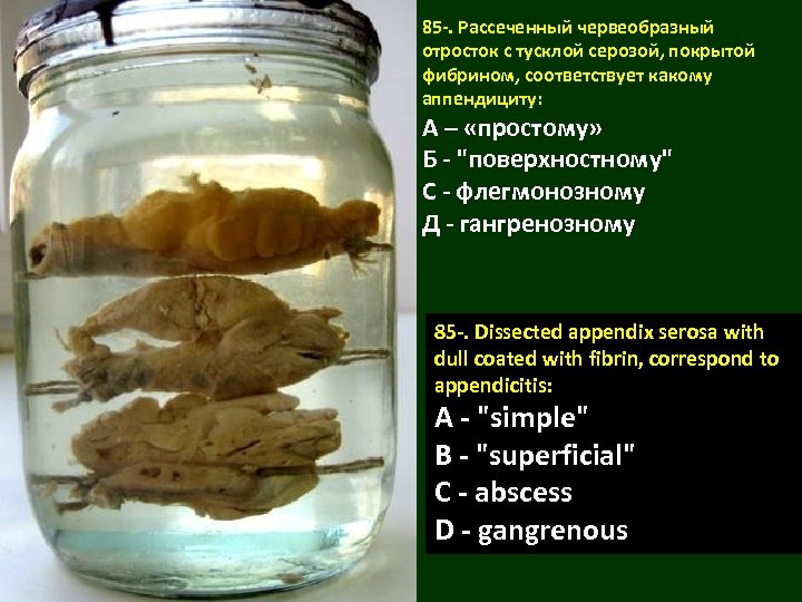 85 -. Рассеченный червеобразный отросток с тусклой серозой, покрытой фибрином, соответствует какому аппендициту: А