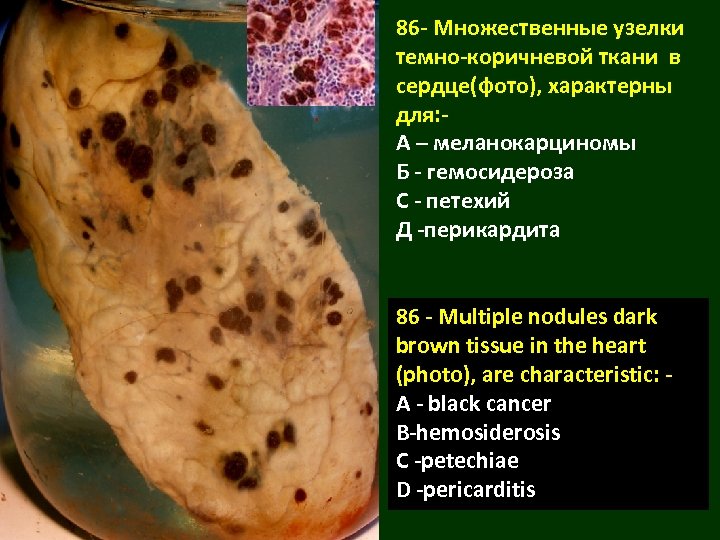 86 - Множественные узелки темно-коричневой ткани в сердце(фото), характерны для: А – меланокарциномы Б